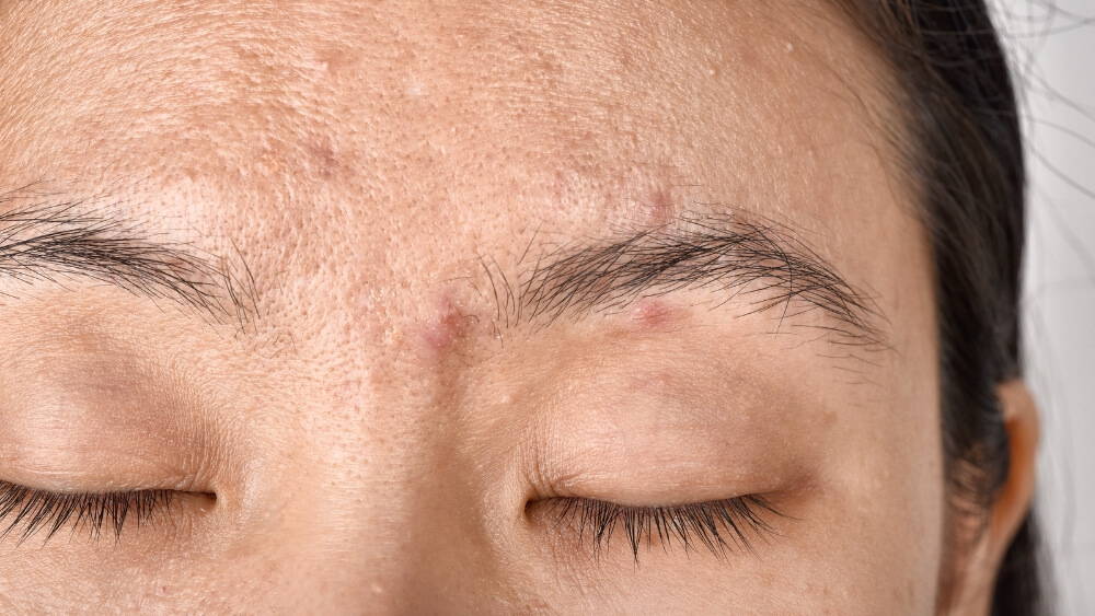 Conquering Hyperpigmentation & Uneven Skin Tone | Radiant Complexion Tips