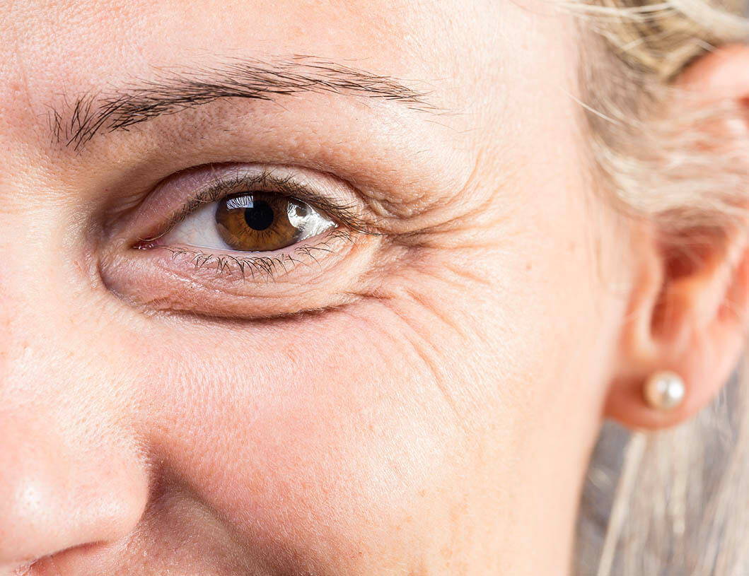 5 Ways to Kiss Wrinkles Goodbye